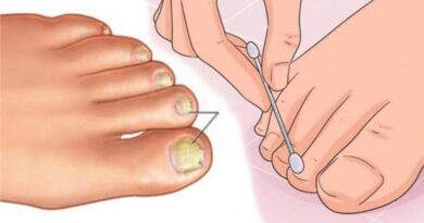 Banish fungal nails with this effortless homemade remedy!